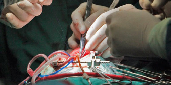 операция по трансплантации