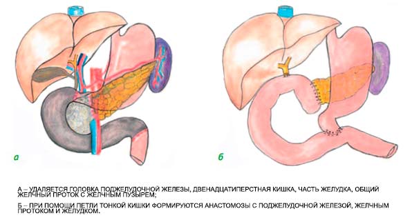 удаление головки поджелудочной железы